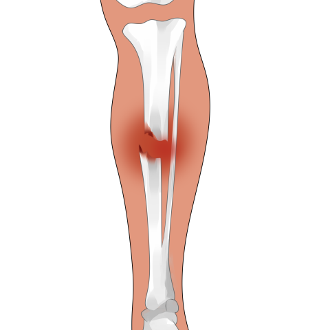 รูปภาพกระดูกขาหัก เครดิตภาพ ขา PNG ออกแบบโดย 588ku จาก <a href=